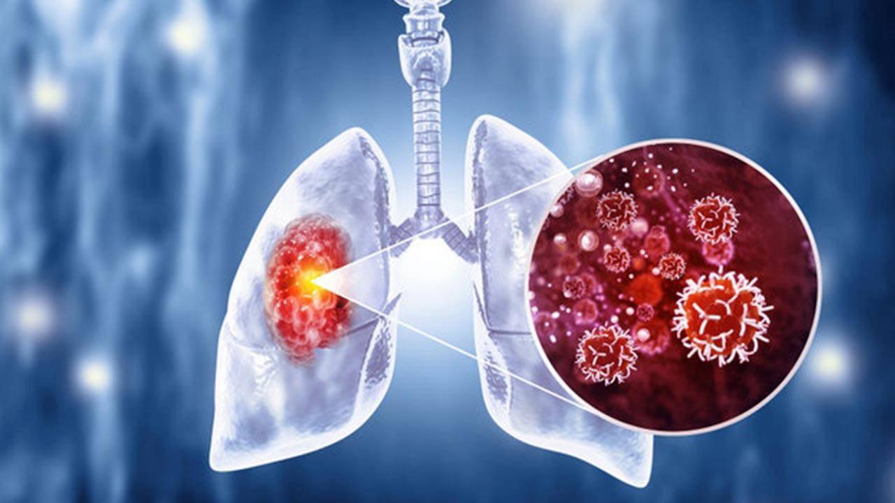 50 Yaş Üstü Sigara İçicileri İçin Yılda Bir Tarama Kritiktir!