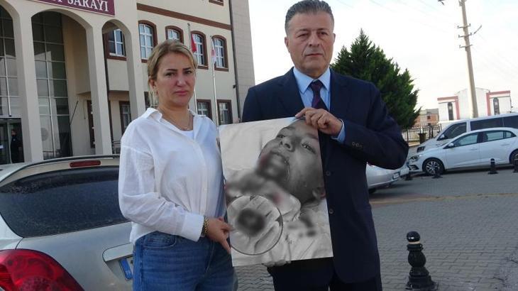 Okulda korkunç olay! 7 yaşındaki Kuzey Yiğit’in demir saplanan çenesi koptu