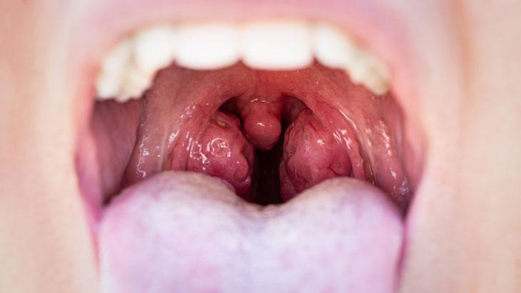 Anne-babalar dikkat! Geniz eti büyümesi çocukların okul başarısını düşürüyor 2 Anne-babalar dikkat! Geniz eti büyümesi çocukların okul başarısını düşürüyor