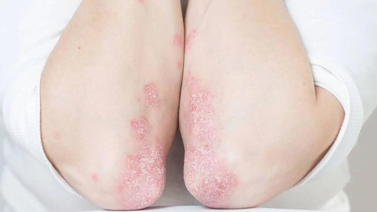 Bir bağışıklık sistemi hastalığı: Lupus bayanlarda 9 kat fazla görülüyor!