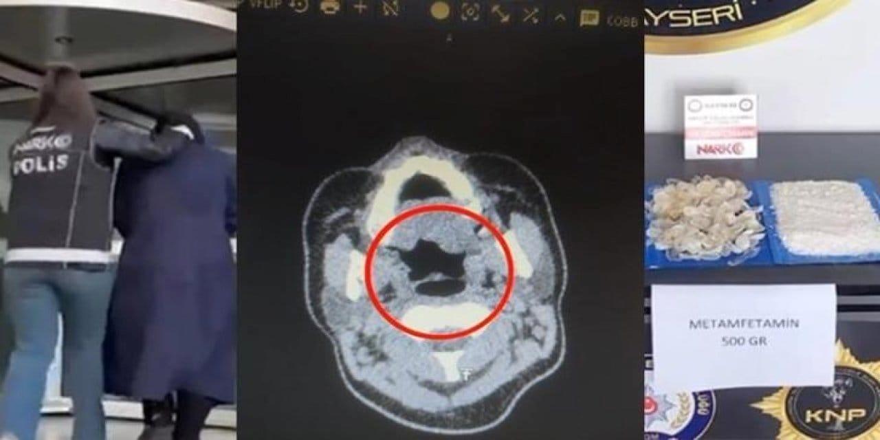 Doktorlar Şokta: Midesinden 500 Gram Metamfetamin Çıkan Hasta!