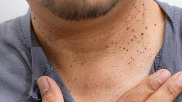 Evde et benlerinden kurtulmak mümkün! Mutfaktaki tek malzeme yetiyor 1 Evde et benlerinden kurtulmak mümkün! Mutfaktaki tek malzeme yetiyor