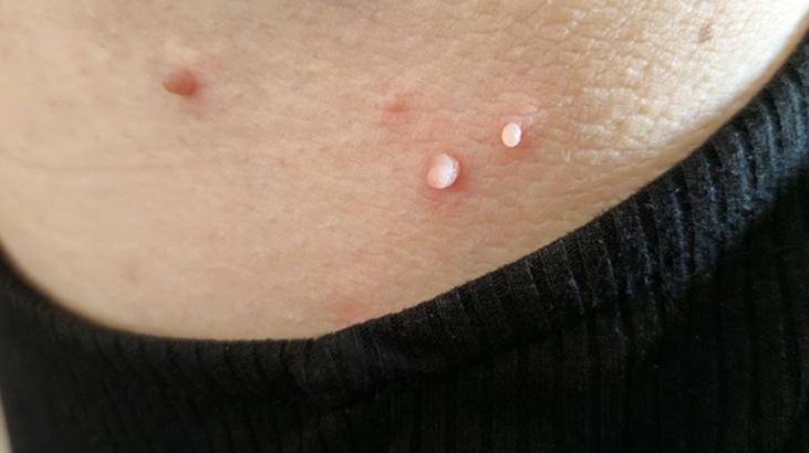 Evde et benlerinden kurtulmak mümkün! Mutfaktaki tek malzeme yetiyor 2 Evde et benlerinden kurtulmak mümkün! Mutfaktaki tek malzeme yetiyor