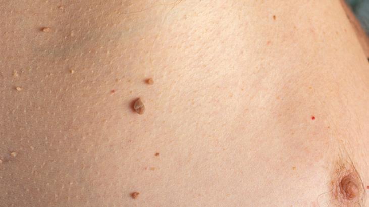 Evde et benlerinden kurtulmak mümkün! Mutfaktaki tek malzeme yetiyor 3 Evde et benlerinden kurtulmak mümkün! Mutfaktaki tek malzeme yetiyor