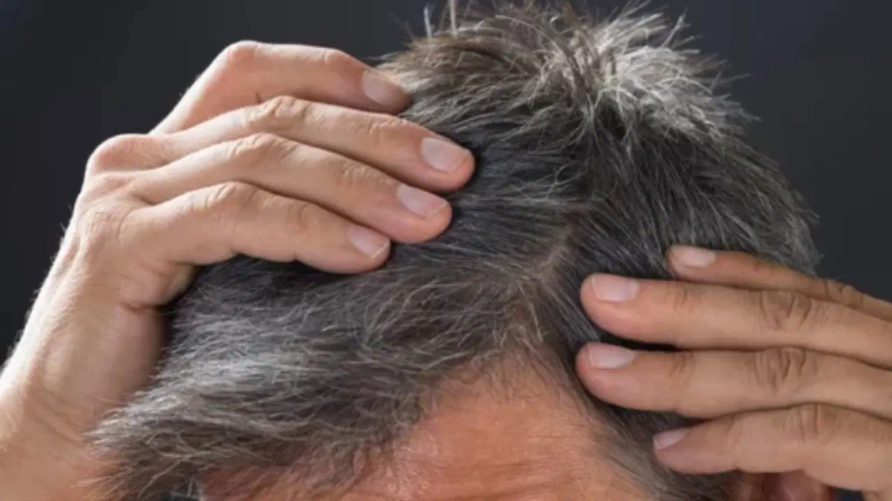 Gençlikte saç beyazlamasının nedeni ortaya çıktı: Kansere karşı bedenin zımnî savunması olabilir 1 Gençlikte saç beyazlamasının nedeni ortaya çıktı: Kansere karşı bedenin zımnî savunması olabilir