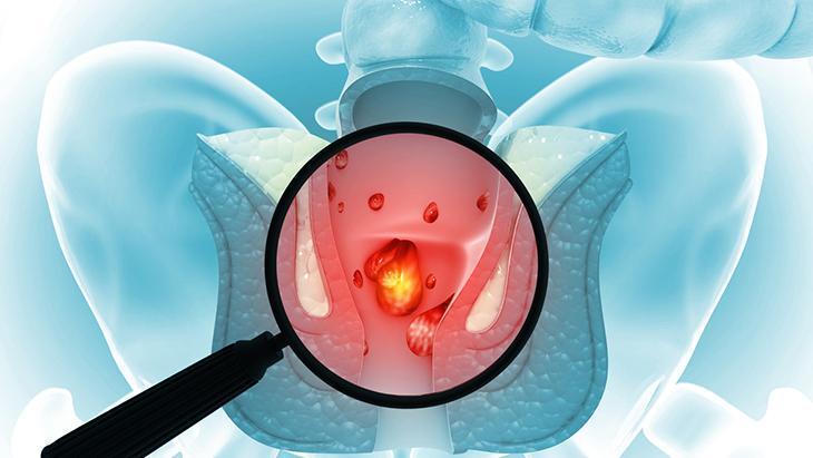 Hemoroid tedavisinde cerrahi şart mı? Uzmanından ameliyatsız çözümler