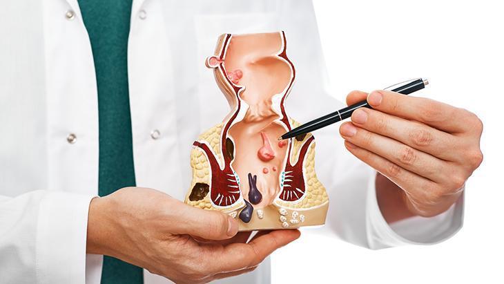Hemoroid tedavisinde cerrahi şart mı? Uzmanından ameliyatsız çözümler