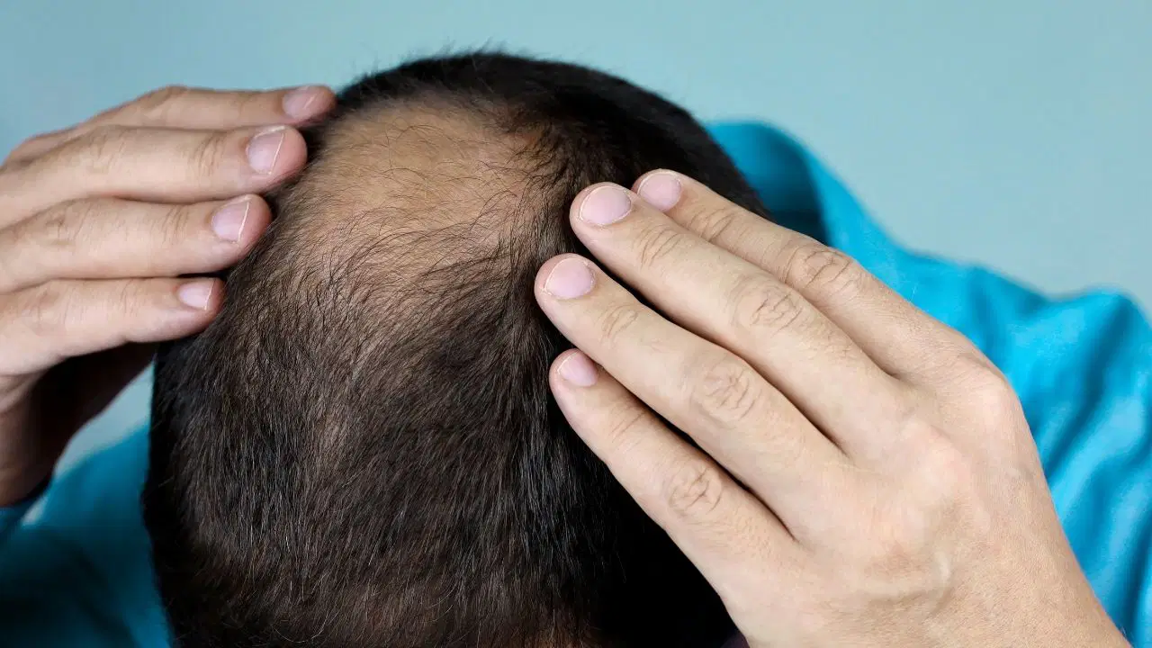 İnsanların inanmayı seçtiği 3 saç dökülme sebebi efsanesi
