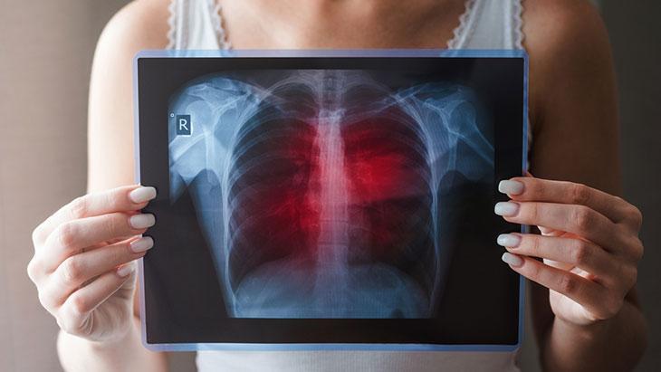 Kadınlarda akciğer kanseri artıyor! Genellikle tesadüfen teşhis ediliyor