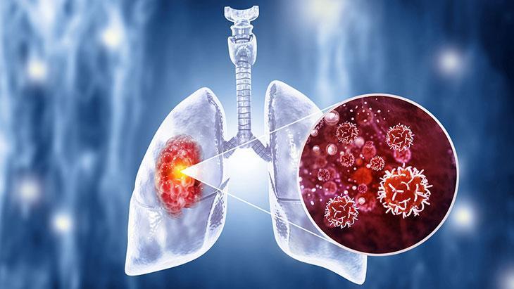 Kadınlarda akciğer kanseri artıyor! Genellikle tesadüfen teşhis ediliyor