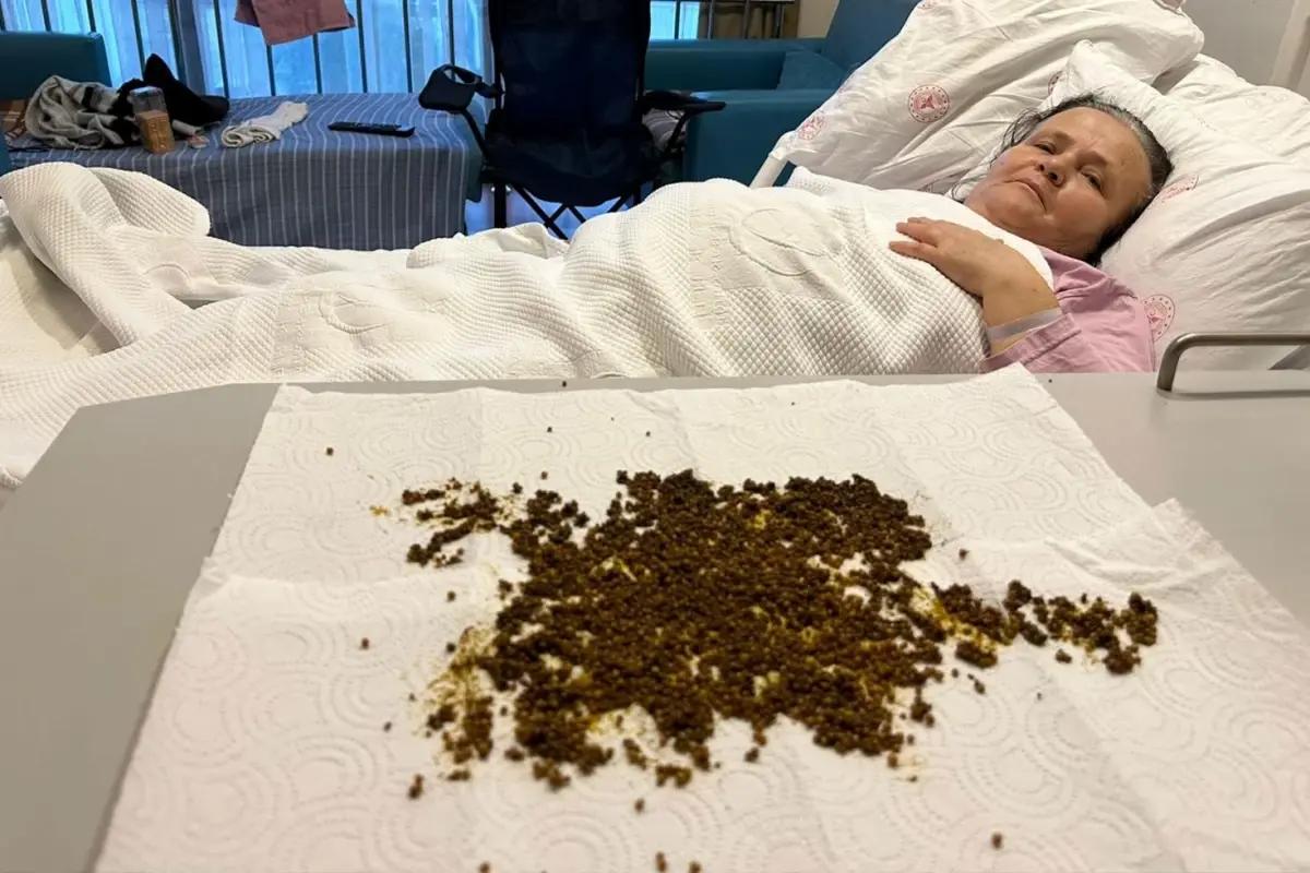 Karın ağrısı şikayetiyle gitti, safra kesesinden 20 bin taş çıkarıldı