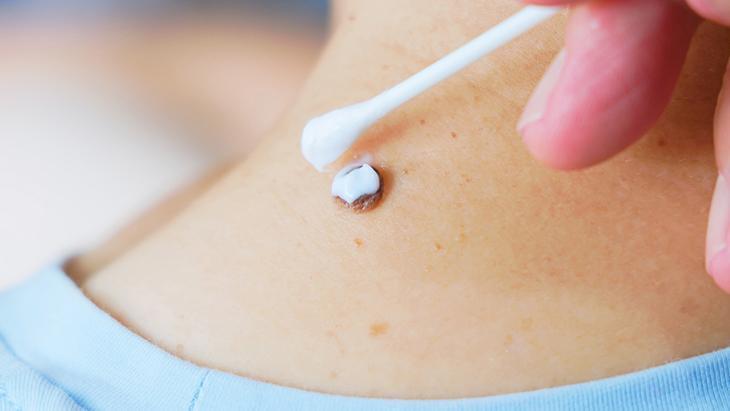 Lazer de yaptıran da var, solüsyon süren de! ‘Her ben masum değil, incelenmeli’