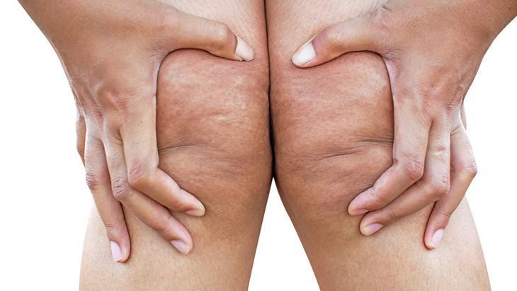 Lipödem kadınların sessiz çığlığı! 'Neden kilo veremiyorum' diyenler için cevap 1 Lipödem kadınların sessiz çığlığı! 'Neden kilo veremiyorum' diyenler için cevap