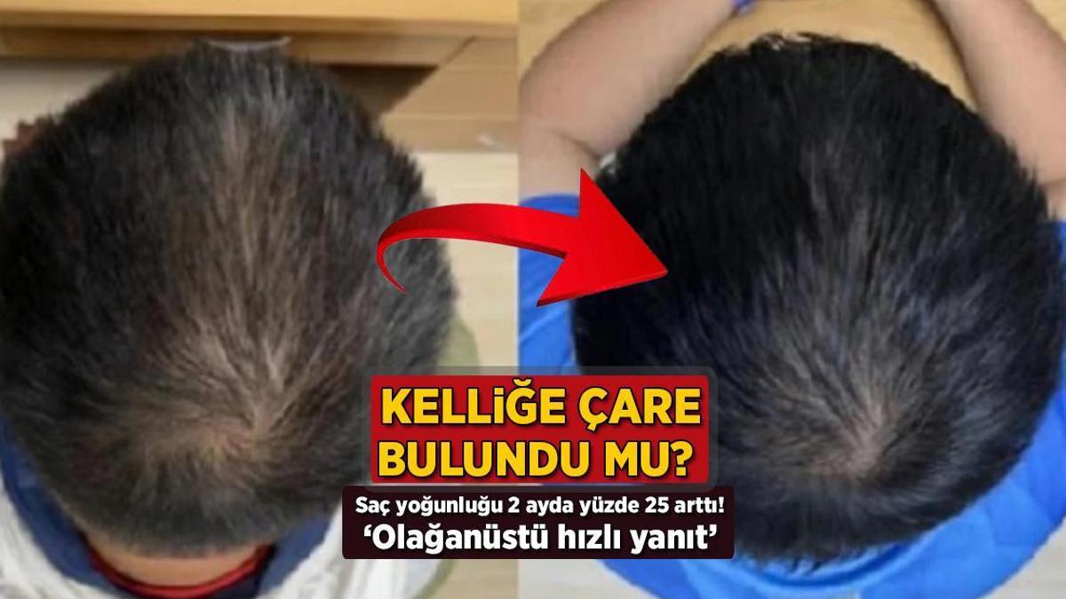 Saç yoğunluğu 2 ayda yüzde 25 arttı: Kelliğin çaresi bu serum mu? İşte gerçek