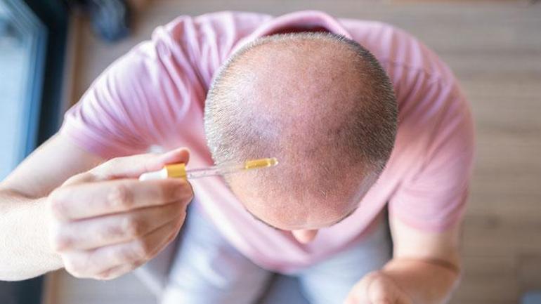 Saç yoğunluğu 2 ayda yüzde 25 arttı: Kelliğin çaresi bu serum mu? İşte gerçek