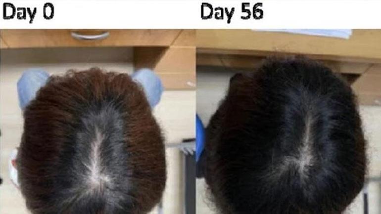 Saç yoğunluğu 2 ayda yüzde 25 arttı: Kelliğin çaresi bu serum mu? İşte gerçek