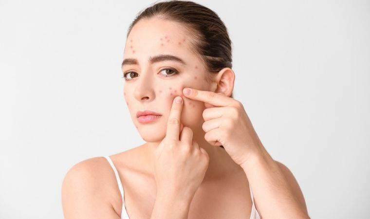 Sofranızdaki bilinmeyen tetikleyiciler cilt bariyerinizi bozuyor olabilir: Akne sorununu tetikleyen 7 besin