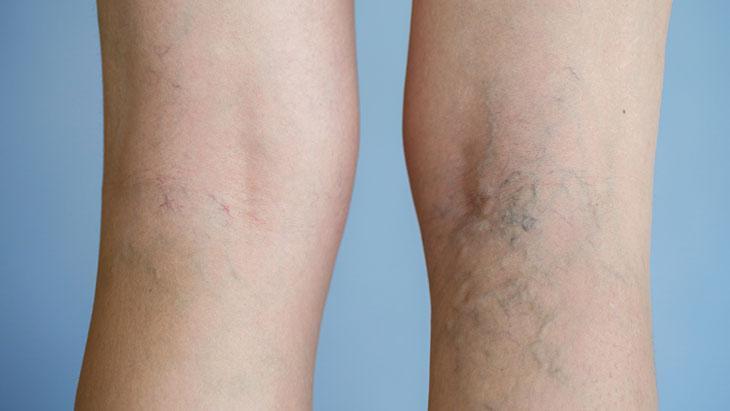 Son yıllarda hızla yaygınlaşıyor! Bu hatalar varise davetiye çıkarıyor