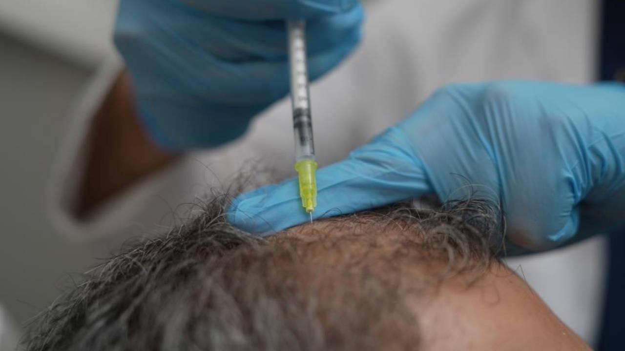 Telogen, saçkıran, erkek tipi dökülme: Saç dökülmesi bedenin bir alarmı olabilir!