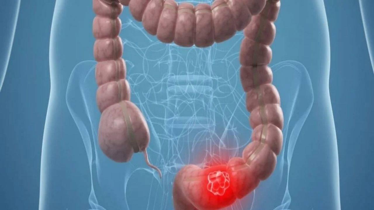 Uzmanından ikaz: İşlenmiş besinler erken yaşta bağırsak kanserine yol açabiliyor