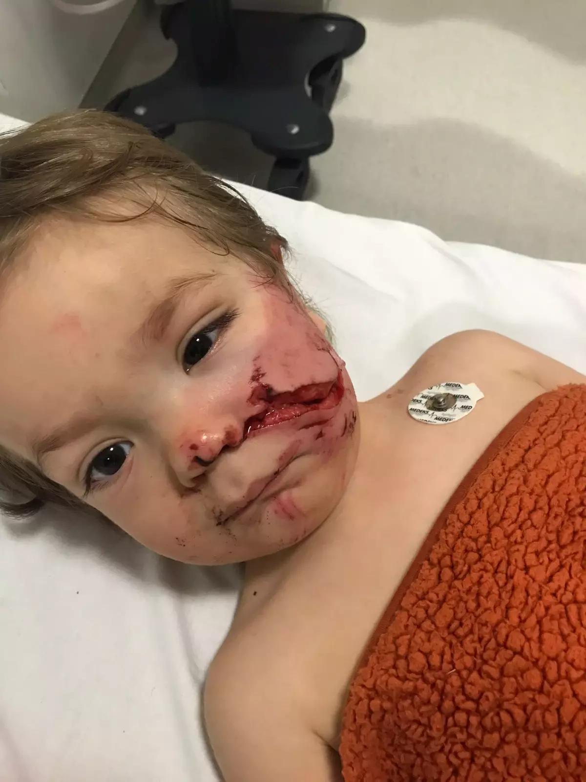 Pitbull Taarruzunda İki Çocuk Yaralandı: Baba Öztürk, Sorumluların Cezalandırılmasını İstiyor